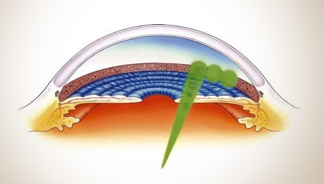 glaucoma chirurgia laser