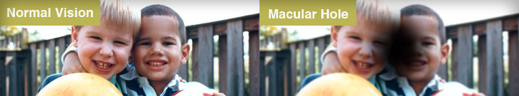 foro maculare effetti